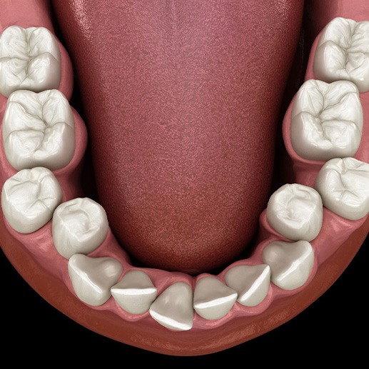 Illustration of crooked teeth