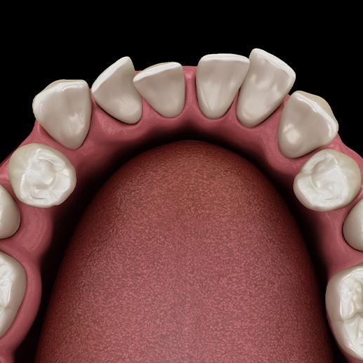 Illustration of gapped teeth