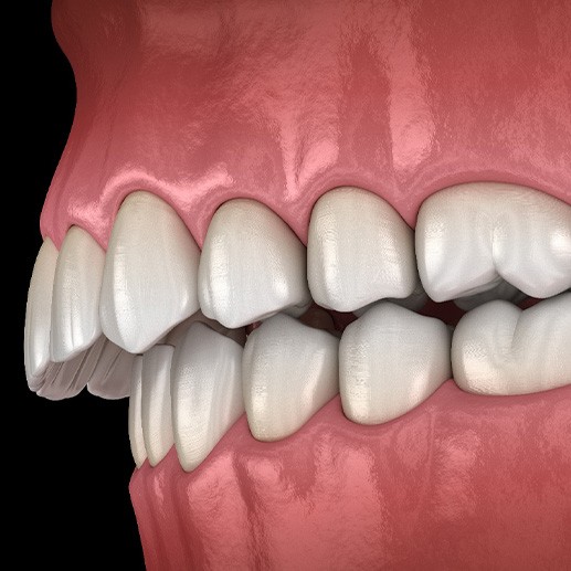 Illustration of an overbite