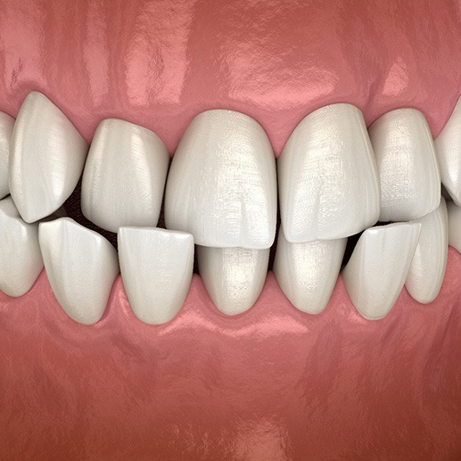 Illustration of a crossbite
