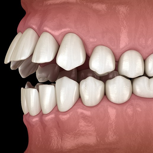 Illustration of an open bite