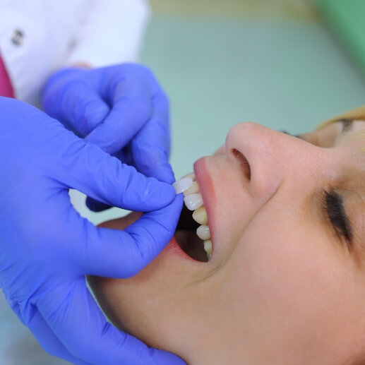 Dentist placing a veneer on a tooth