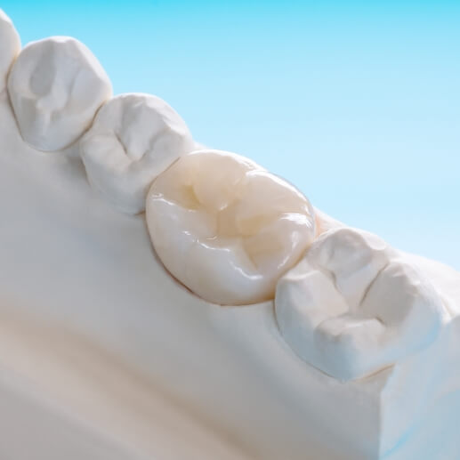 Dental crown covering a tooth in a model of the mouth