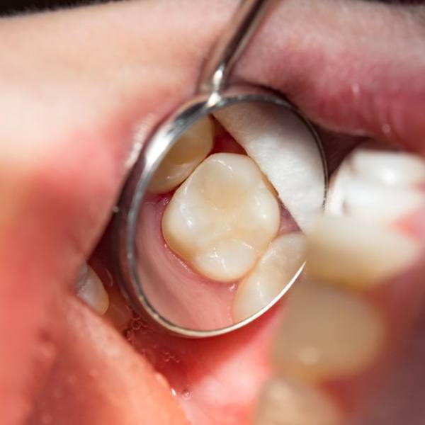 Close up of a patient’s seamlessly treated tooth