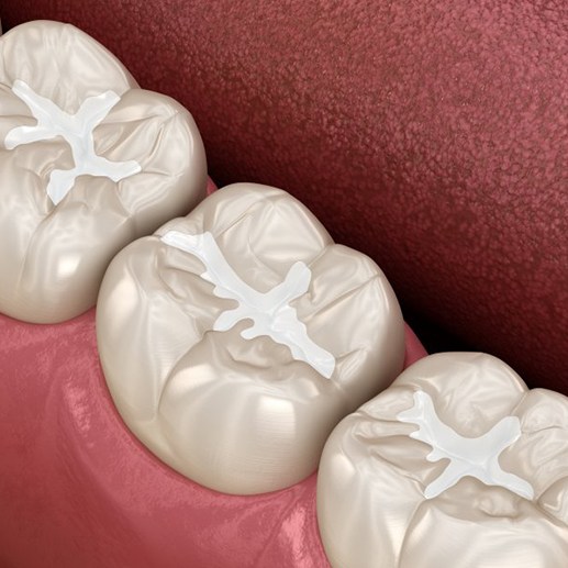 Digital image of tooth-colored fillings in three teeth