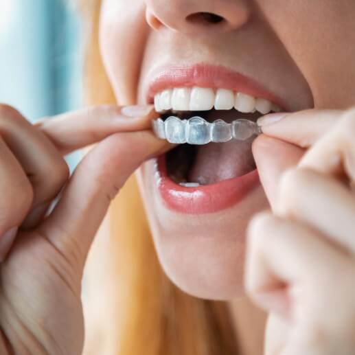 Close up of person placing Invisalign tray over their teeth