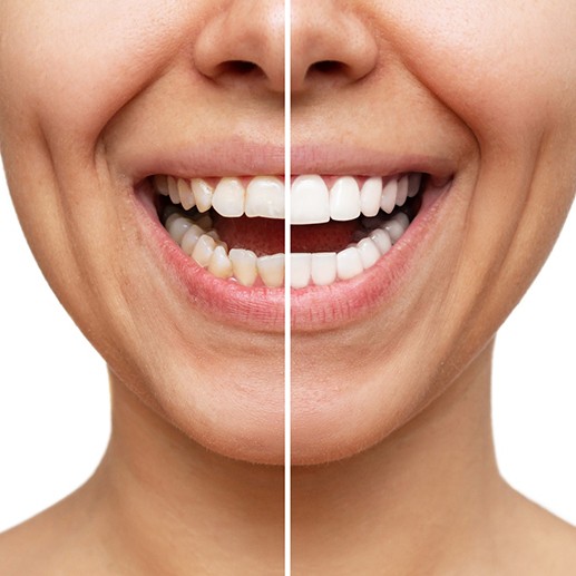 A before and after image of a woman’s smile