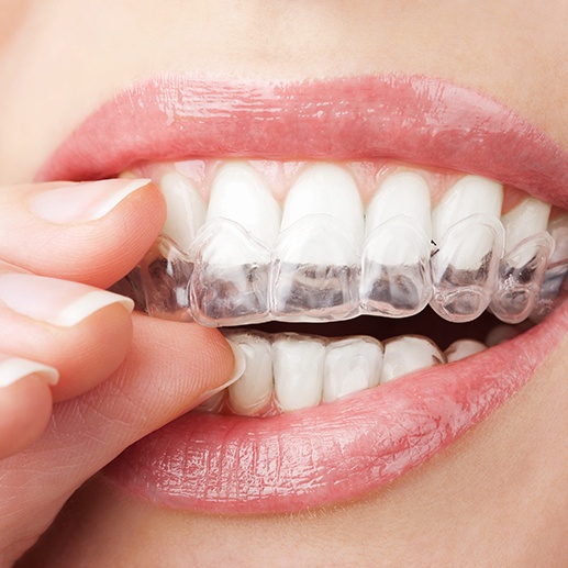 A patient placing a teeth whitening gray over their smile