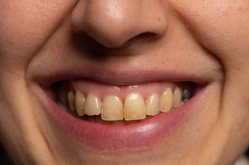 A closeup of a smile with stained teeth